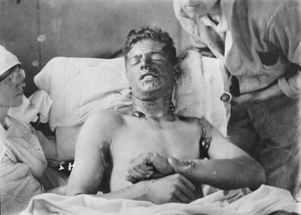 What all the fuss was about. A Canadian soldier from WW1 suffering from Mustard gas poisoning